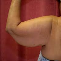 jiggly arms Jiggly Arms